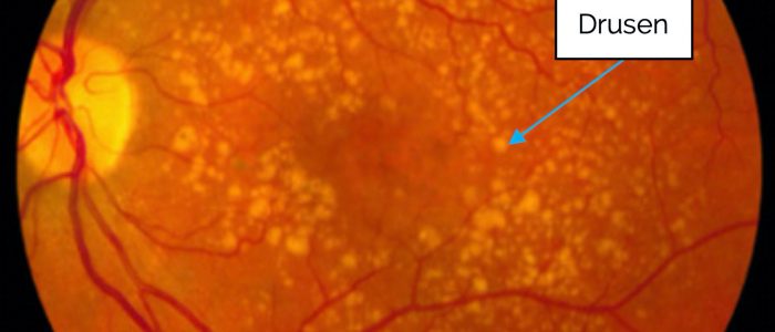Drusen in age-related macular degeneration