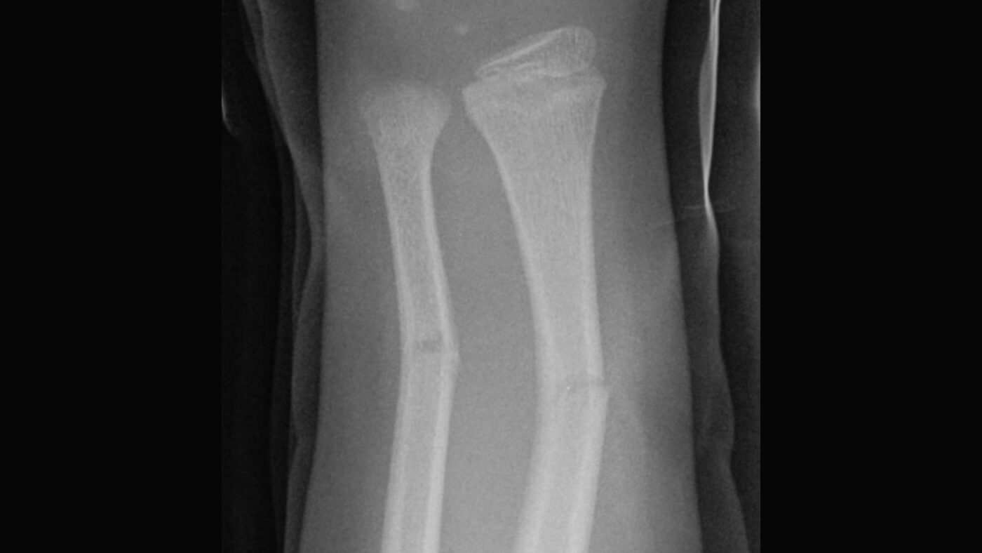 greenstick fracture distal radius