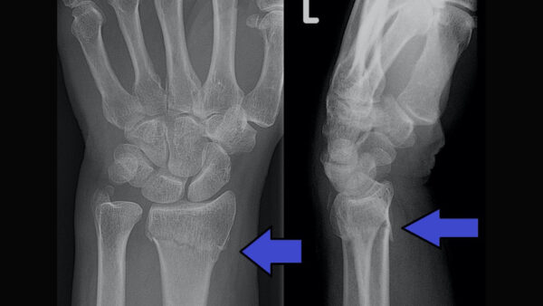 Impacted fracture