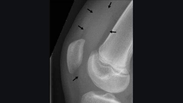 Knee effusion X-ray