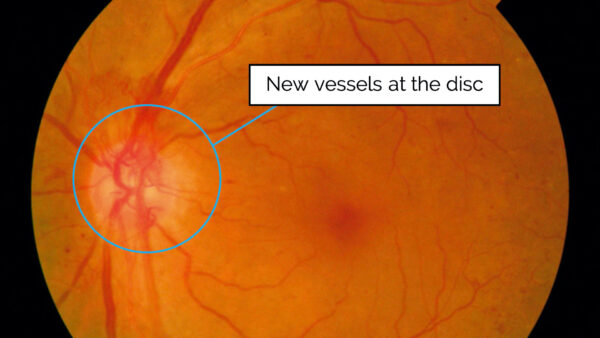 Neovascularisation at the disc