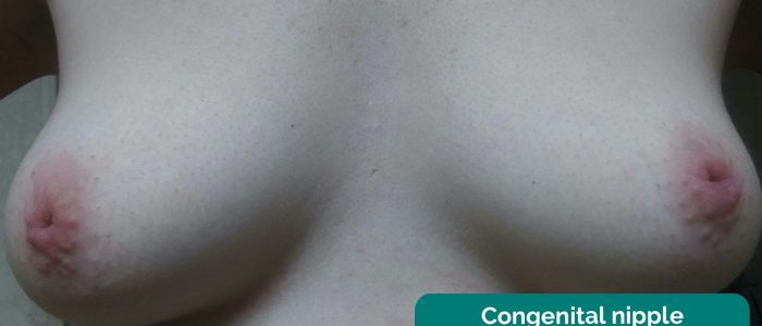Congenital nipple inversion