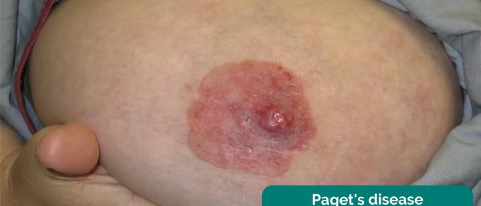 Paget's disease of the nipple