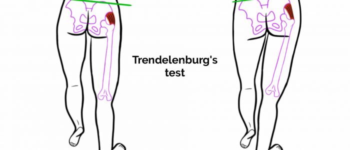 Trendelenburg's test