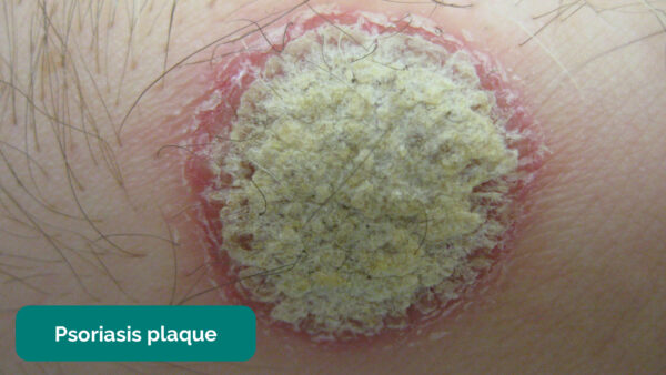 Psoriasis plaque