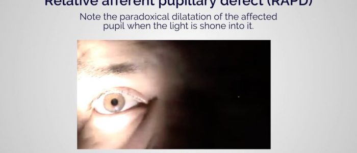 Relative afferent pupillary defect