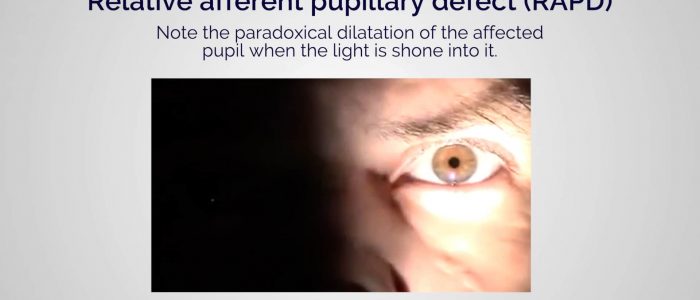 Relative afferent pupillary defect (RAPD)