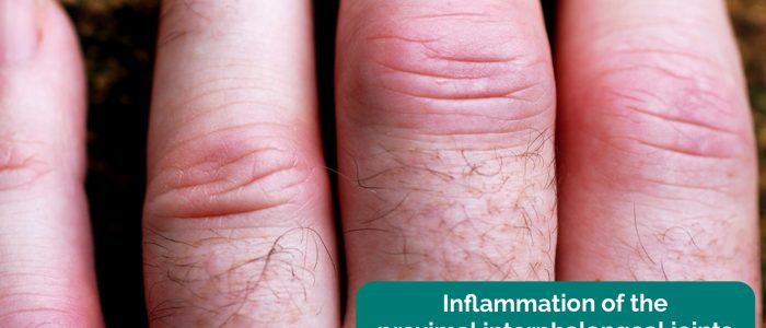 Inflammation of the proximal interphalangeal joints