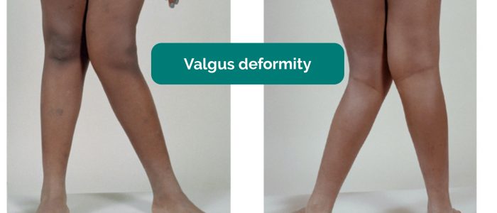 Valgus deformity