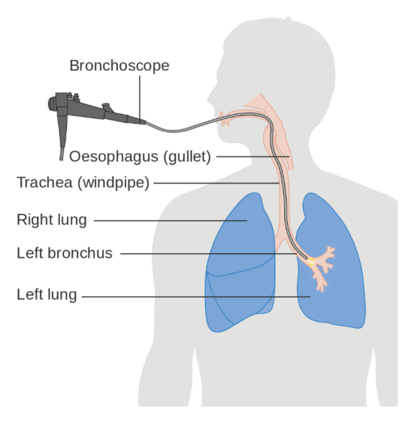 Bronchoscopy diagram