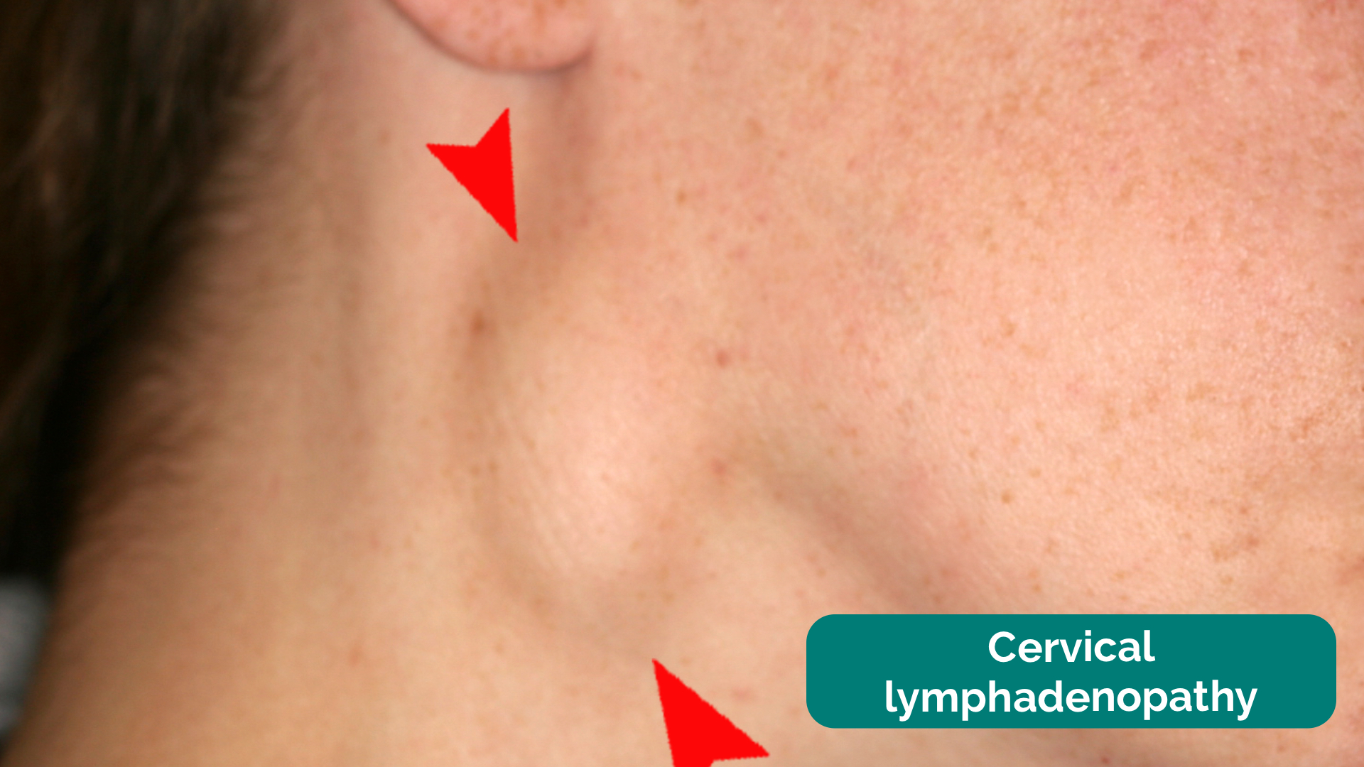 posterior cervical lymph nodes