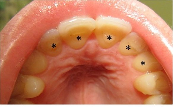 Dental erosion secondary to bulimia
