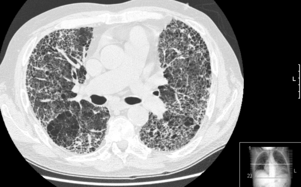 High-resolution CT pulmonary fibrosis