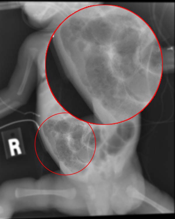 Necrotizing enterocolitis X-ray