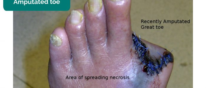 Amputated toe secondary to gangrene