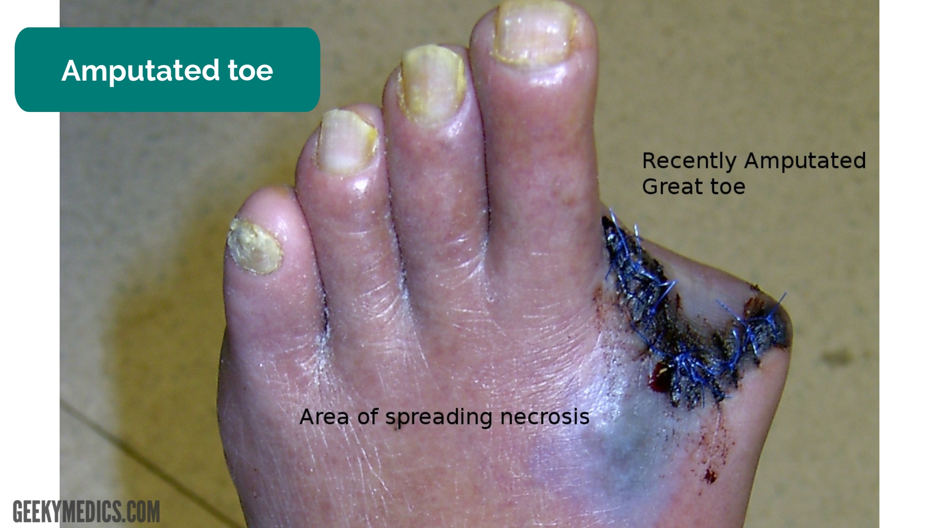 a gangréna foot diabetes mellitus kezelése hidrogén-peroxid)