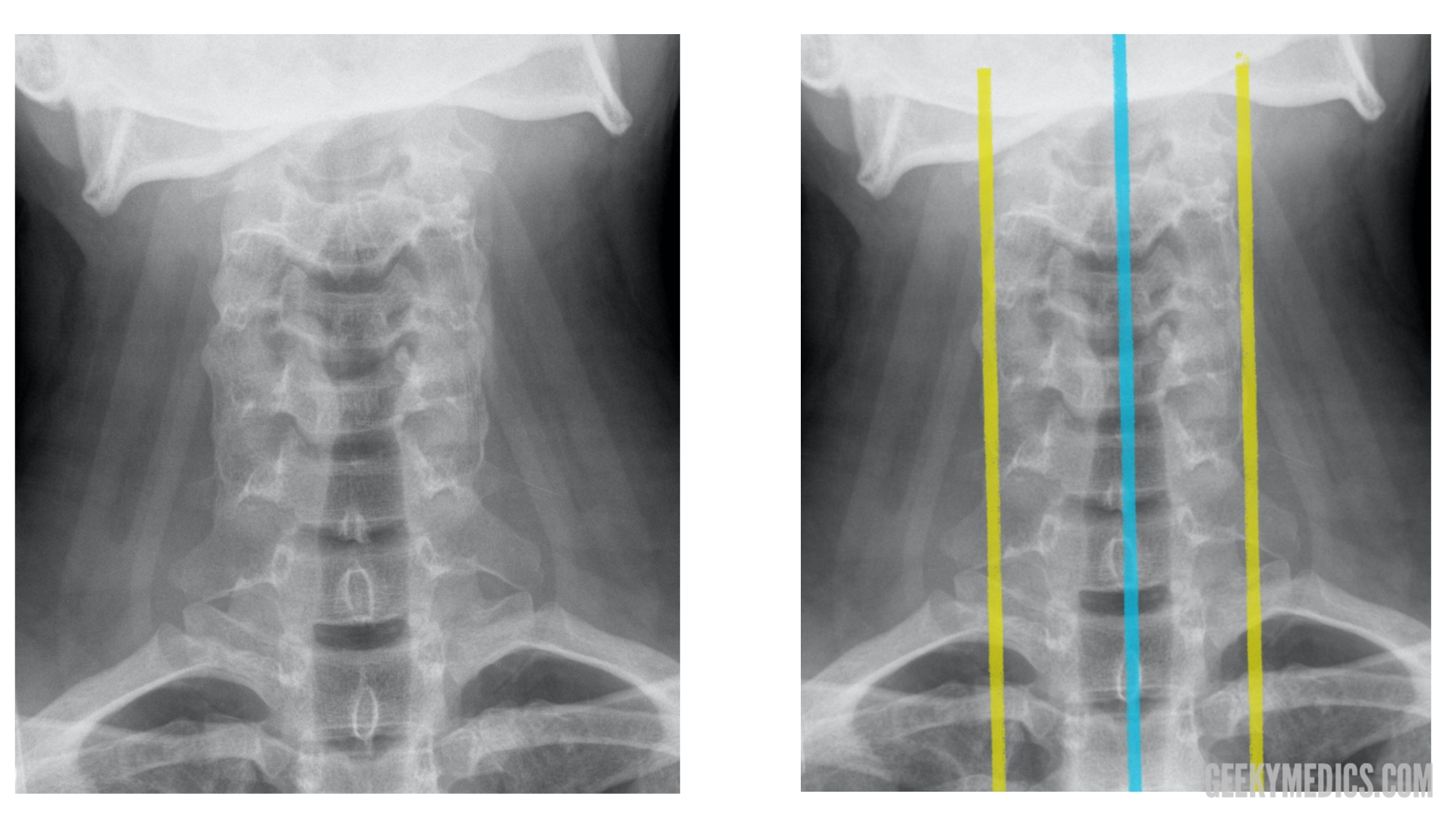 Cervical Spine X-ray Interpretation - OSCE Guide