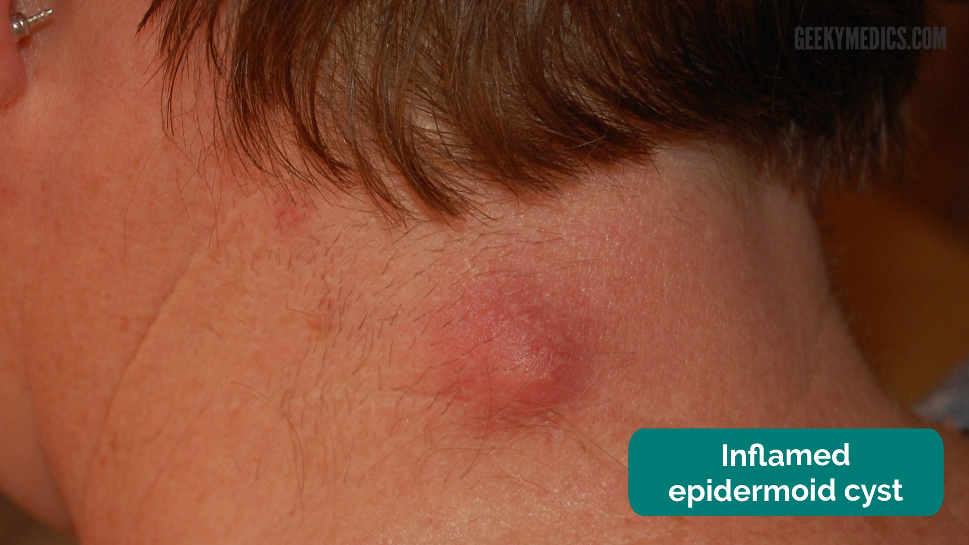 Epidermoid Cyst Pictures