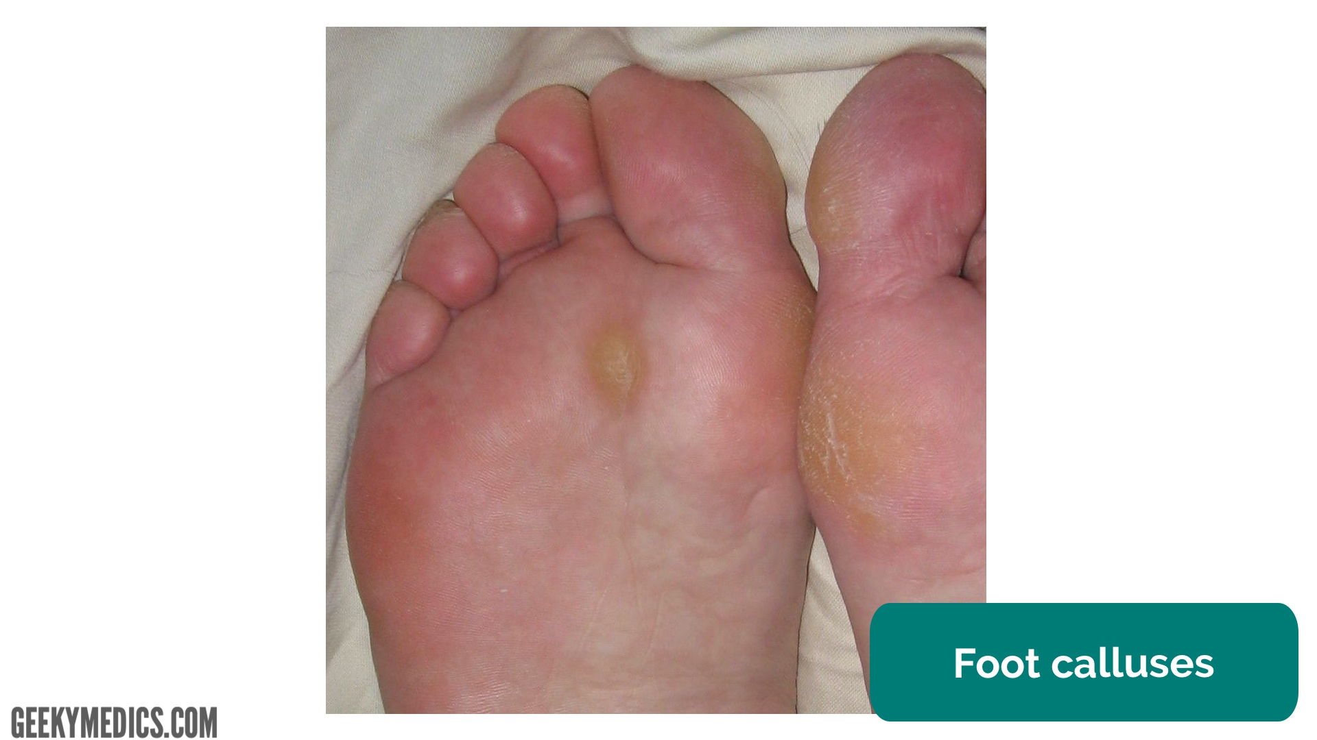 folk kezelések foot diabetes