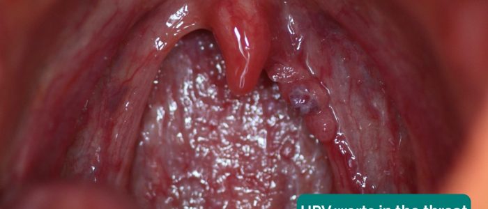 HPV warts in the throat