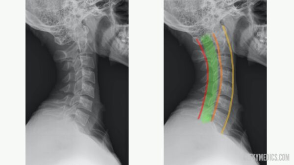 c-spine x-ray lateral annotated