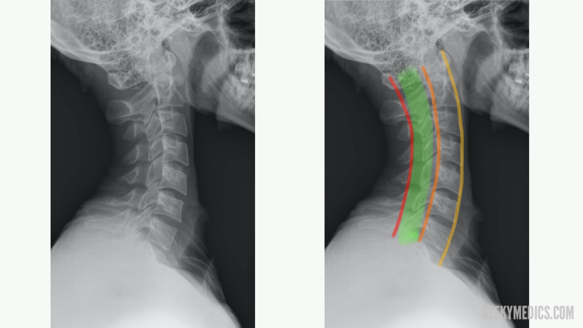 X Ray Of The Cervical Vertebrae X Ray Image Of The Ce - vrogue.co