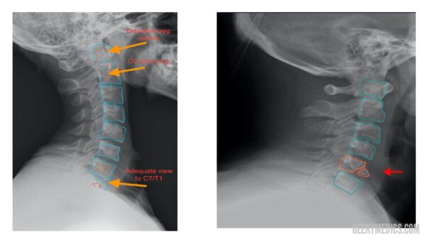 teardrop cervical spine fracture