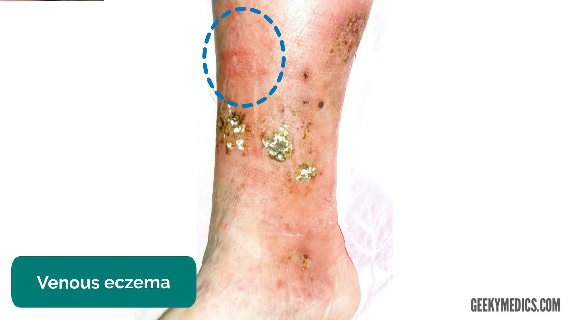 Deteriorarea pielii piciorului în varicoza, Generalitati