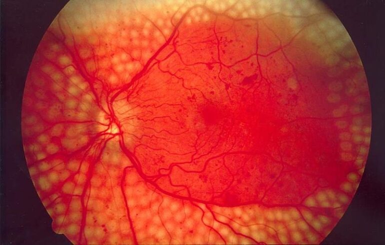 Diabetic Retinopathy | Clinical Features | Geeky Medics