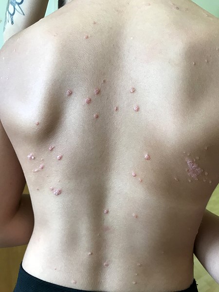 Guttate psoriasis in a 9 year old girl. 