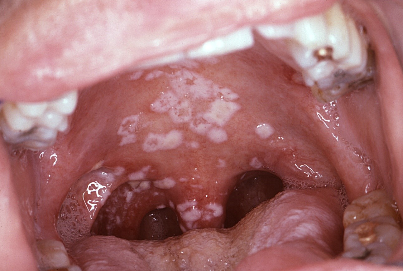Figure 2. Oral candidiasis in a HIV-positive patient.6.
