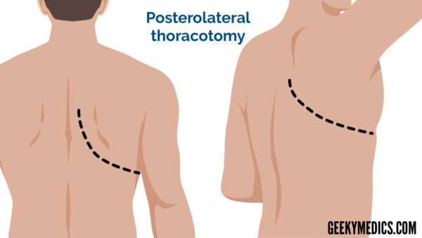 Posterolateral thoracotomy - cardiothoracic incisions