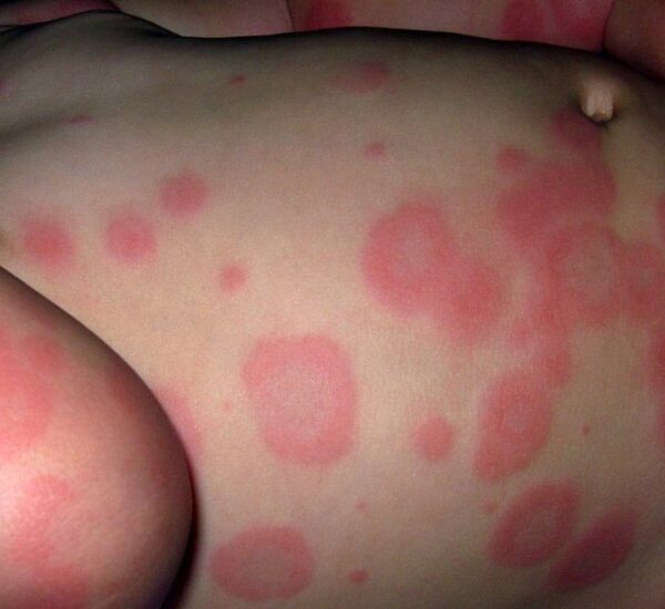Erythema multiforme on the trunk