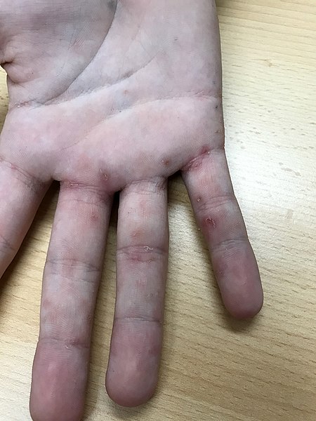 Scabies affecting the hand and fingers of a Caucasian child