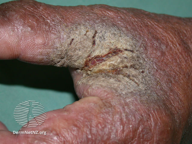 Scabies (Skin Condition)  What Is It, Classic vs. Crusted Types, Signs &  Symptoms, Treatment 