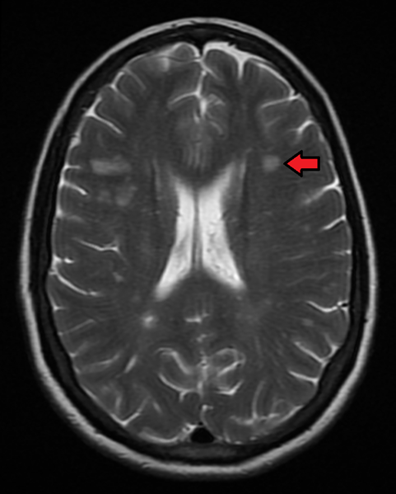 MRI Brain, T2 sequence demonstrating enhancement of a juxtacortical white matter lesion. This is consistent with multiple sclerosis. 