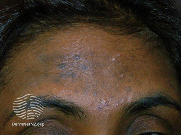 Forehead acne in a South-Asian woman, showing post-inflammatory hyperpigmentation