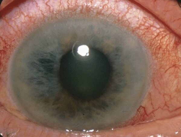 Angle-closure glaucoma with a mid-dilated pupil