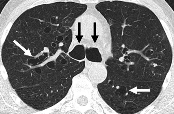 CT chest of bronchiectasis