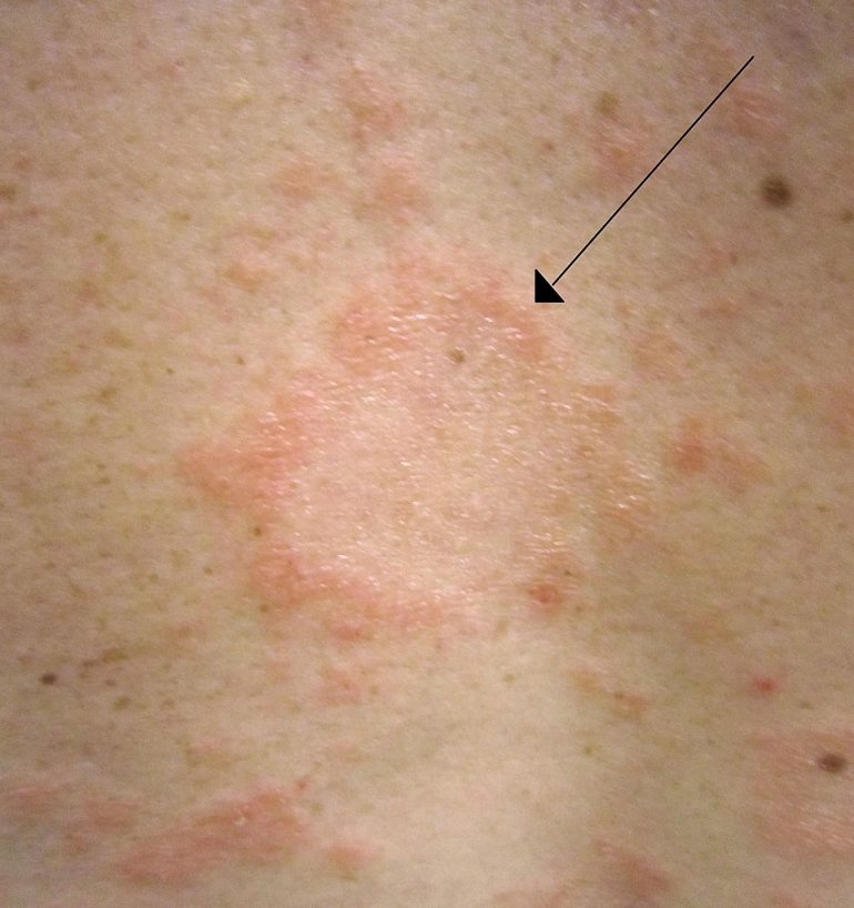 herald patch pityriasis rosea causes