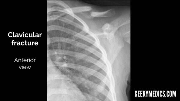 Clavicular fracture