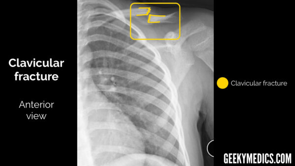 Clavicular fracture