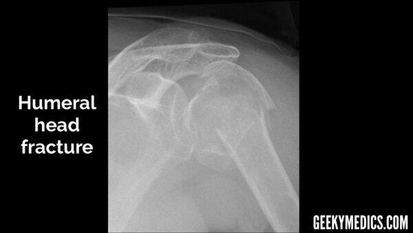 Humeral head fracture