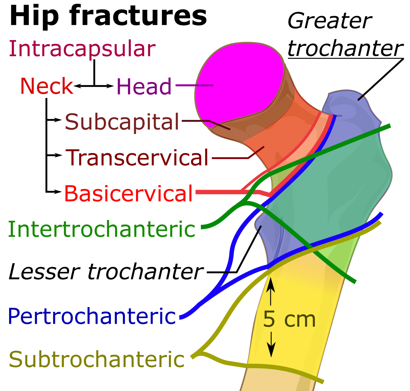 icd 10 code for left intertrochanteric fracture