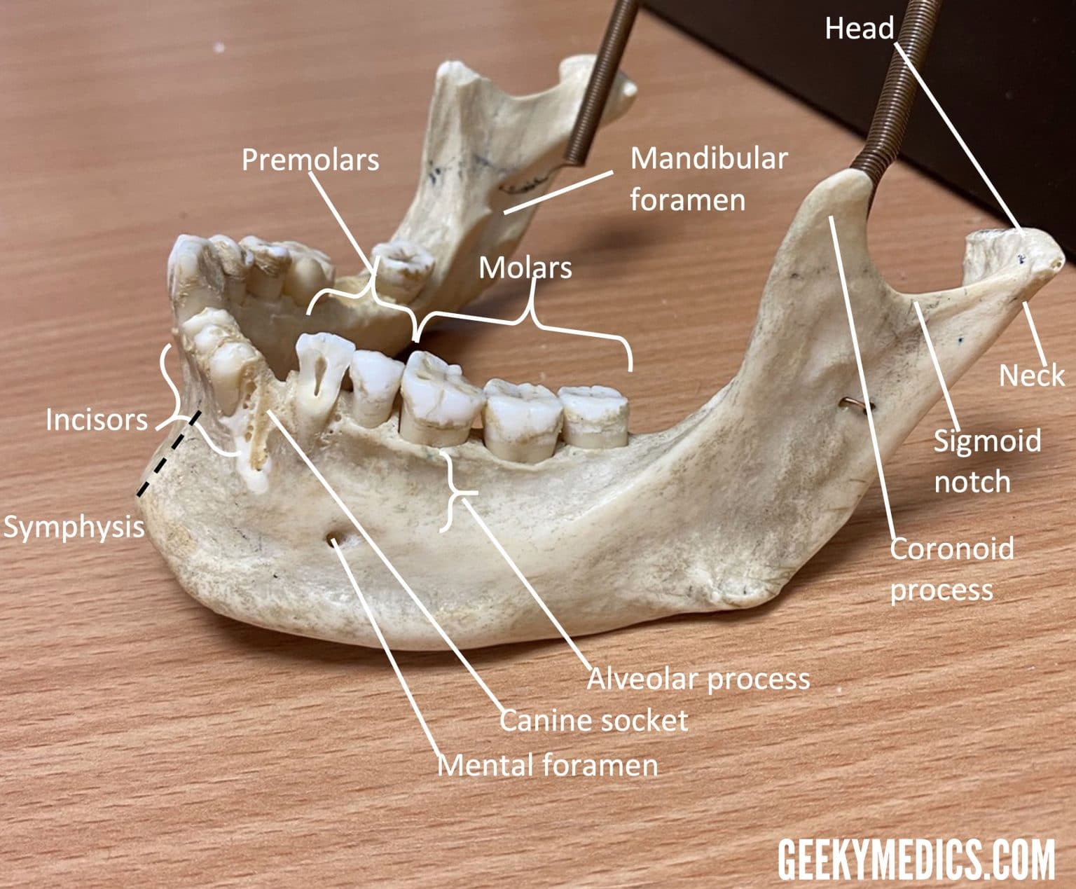 Mandibular Fractures | Anatomy, Management | Geeky Medics