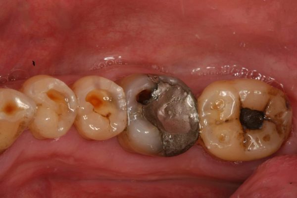 Erosion: cupped occlusal surfaces