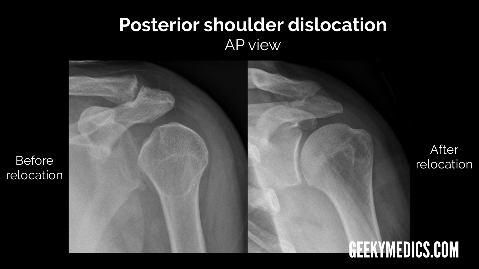 Anterior, Posterior Shoulder Dislocation Support
