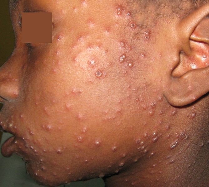 Chickenpox (VZV)