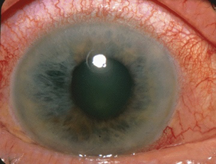 An example of acute angle-closure glaucoma