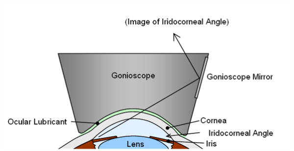 A diagram showing how gonioscopy works